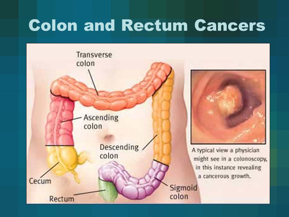 Alimentos que producen cancer de colon